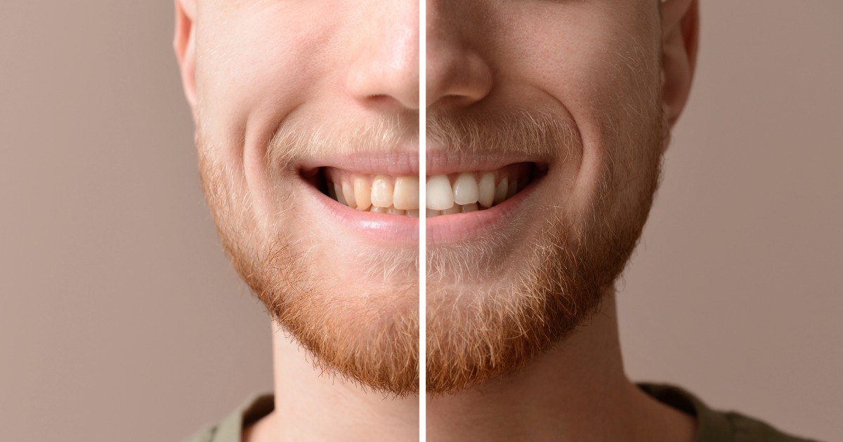 a split photo showing before and after of teeth whitening